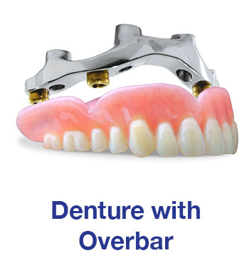 Denture with Overbar